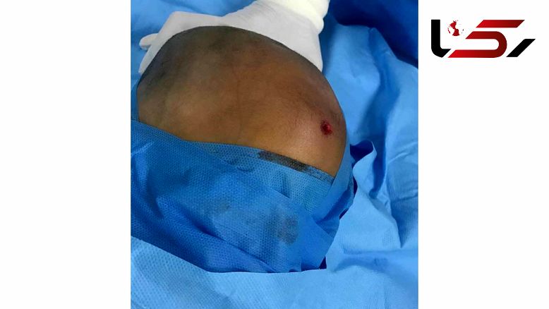 اصابت گلوله به سر کودک 2 ساله لارستانی / او معجزه آسا زنده ماند + عکس