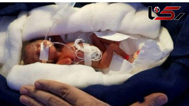 عکسی عجیب از نوزادی که نباید زنده می ماند! + برترین عکس