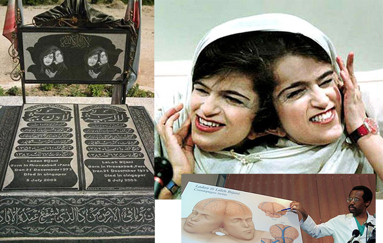  لاله و لادن فداکارترین دو قلوی جهان / به مناسبت سالروز مرگ دلخراش + عکس