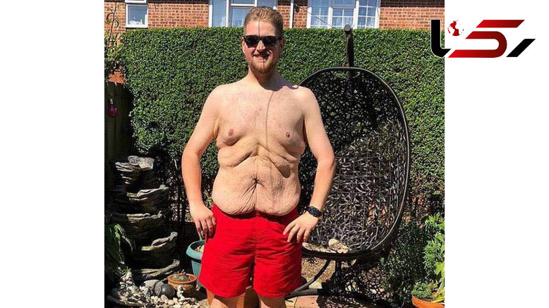  چندش آورترین و زشت ترین شکم  دنیا+عکس