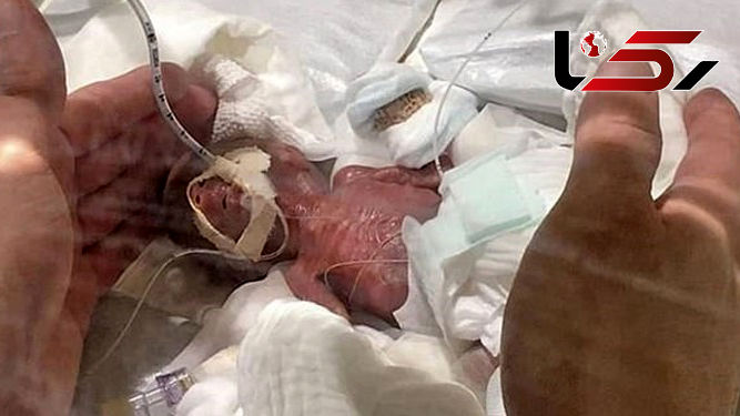 عجیب ترین عکس از تولد کوچکترین نوزاد جهان 