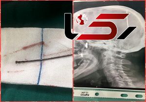 عکس عجیب از میخ فرو رفته در جمجمه مرد ایرانی + تصویر