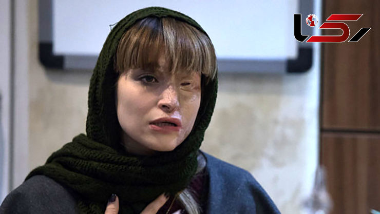 دل نگرانی های مرضیه ابراهیمی که نصف صورتش با اسید سوخته است + عکس